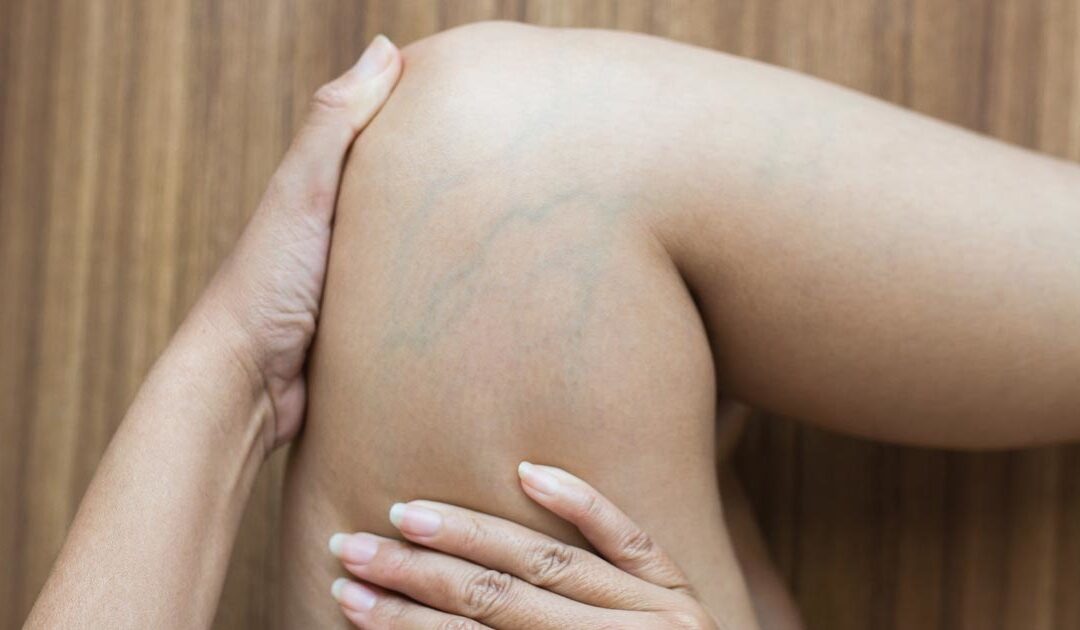 What You Need to Know About Veins