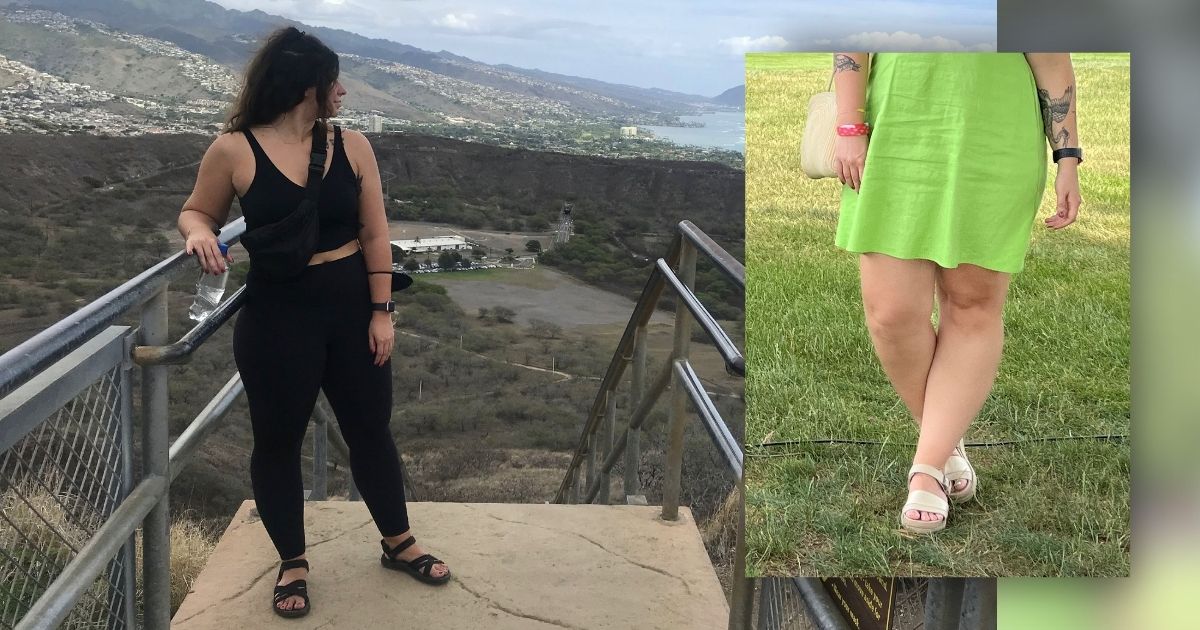 Lipedema symptoms in women Lipedema symptoms in women