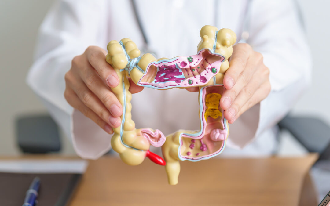 American Cancer Society Updates Colorectal Cancer Screening Guidelines